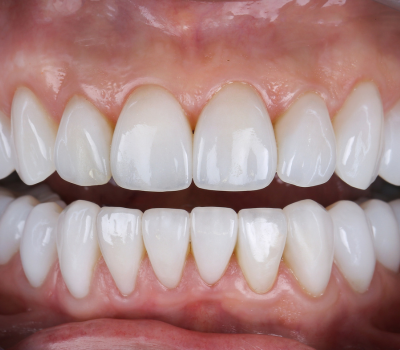 Dental Bridges vs Implants