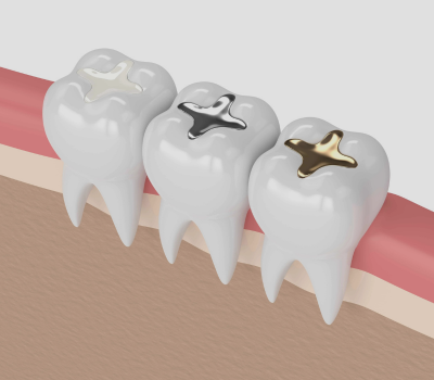 Types of Dental Fillings