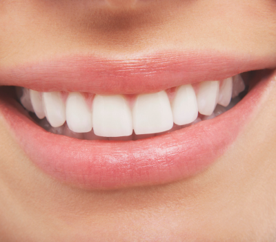 Hollywood Smile